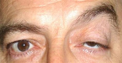 Ptosis: Cause, Symptom, and Treatment | MD-Health.com