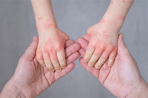 Understanding Hand and Wrist Dermatitis: Symptoms, Causes, and