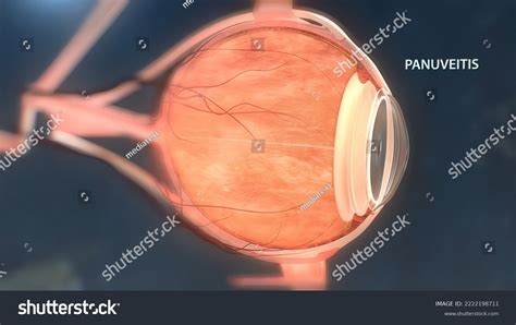 Uveitis Inflammation Part All Uvea Eye Stock Illustration 2222198711 ...