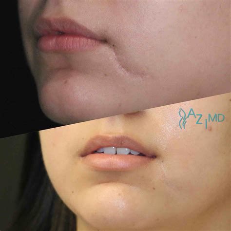 Scar Revision - La Jolla Dermatology