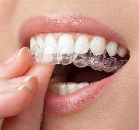 The Challenges of Overcorrection using Clear Aligners