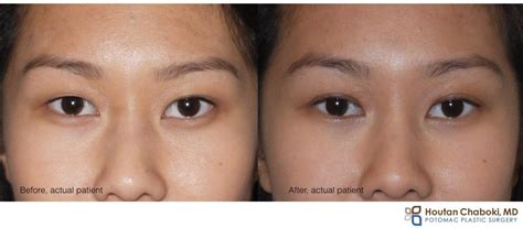 blepharoplasty asian before after Cheaper Than Retail Price> Buy Clothing, Accessories and ...