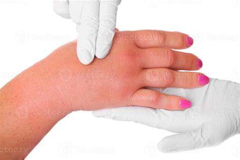 red swollen hand  stock photo  vecteezy