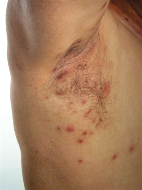 Underarm Rash Pictures: How Irritated Armpits Look