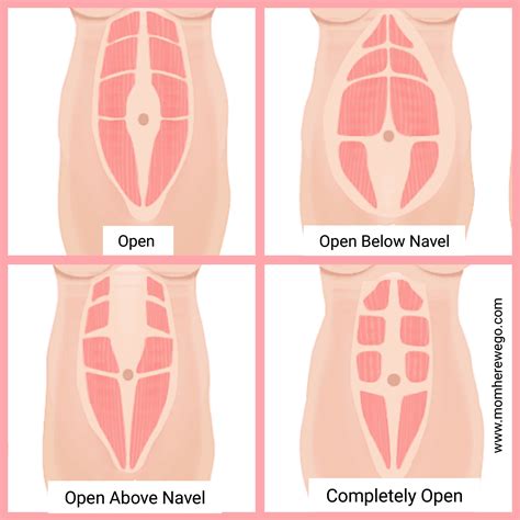 Diastasis Recti – all you need to know – Miry Clicks Photography