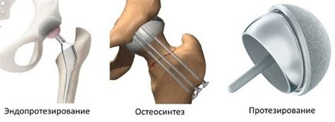 Операция при переломе шейки бедра в пожилом возрасте: показания, виды ...