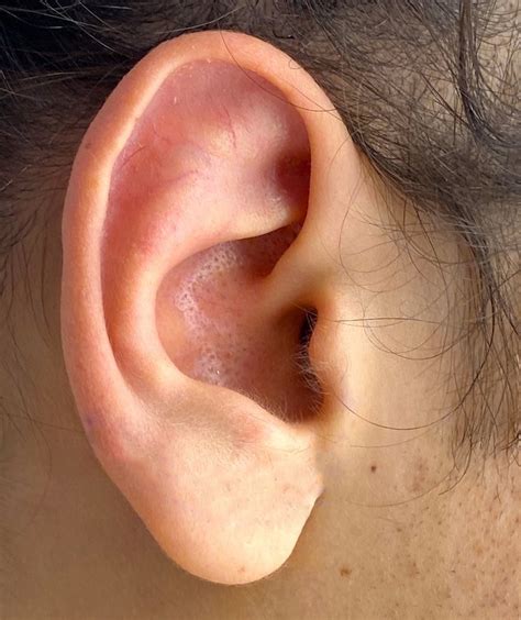 large  ear dr barrty eppley explore plastic surgery