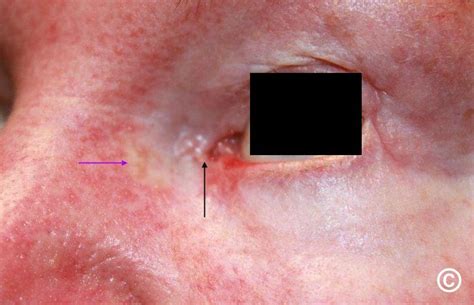 Basal cell carcinoma