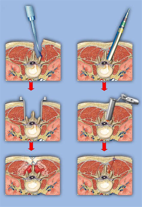 Minimally Invasive Spine Surgery | upmcspinespecialists