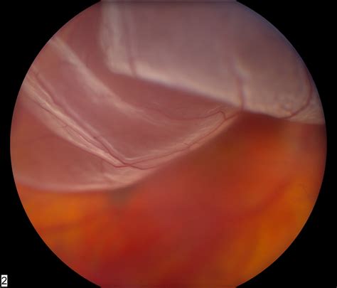 Torn retina surgery - batmanchem