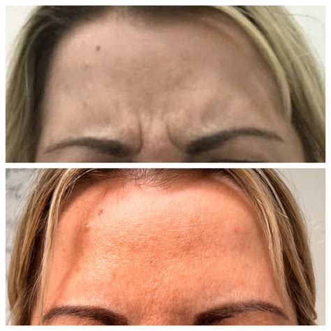 Anti – Wrinkle Injections - Esthe Clinic