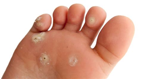 Plantar warts: Assessment and Treatment - Your Total Foot Care