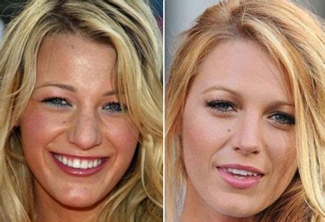 blake lively    plastic surgery stylefrizz