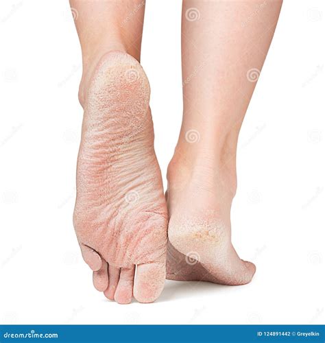 Pots Sore Feet at Scarlett Packham blog