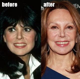 Marlo Thomas Plastic Surgery Before and After Facelift - Star Plastic ...