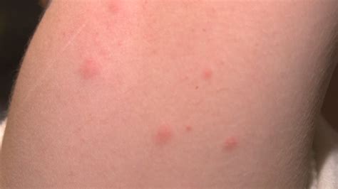 tiny black bugs  house  bite psoriasisgurucom