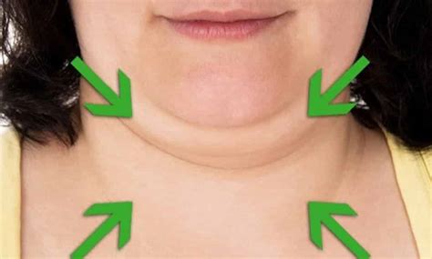 Caroço Na Papada Do Queixo - Como acabar de vez com a papada do pescoço (queixo duplo)