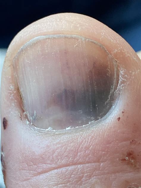 This bruise under my nail looks like a humming bird : r/mildlyinteresting