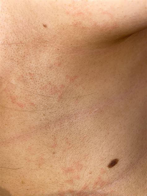 Red rash = psoriasis? : r/Psoriasis