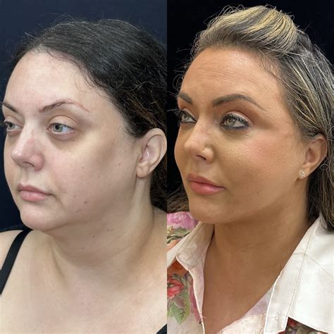 Deep Plane Facelift Before & After Photos | Mansher Singh, MD