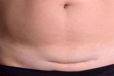 How to Optimize Your Cesarean Recovery – Eco Chic Movement