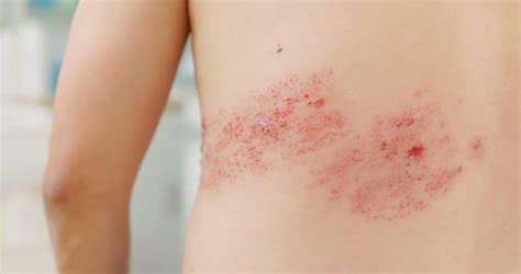 870+ Shingles Rash Stock Photos, Pictures & Royalty-Free Images - iStock