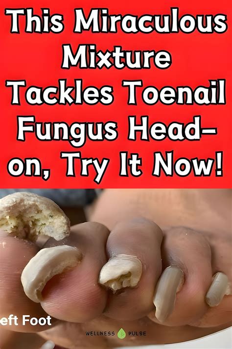 Pin on Toenail fungal infection