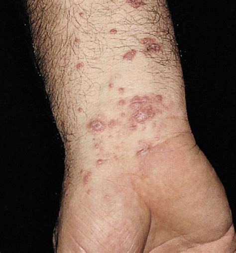 Définition | Psoriasis