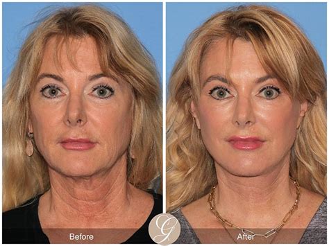 What is Ozempic Face and How To Deal With It | Blog