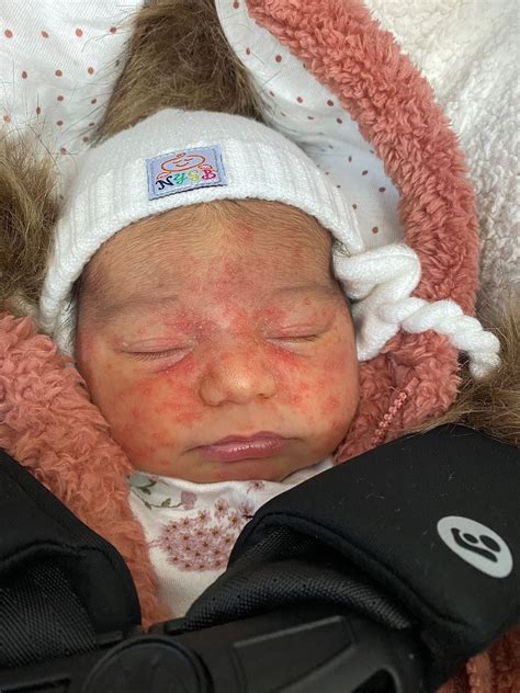 5 Hidden Signs Of Milk Allergies In Newborns: Recognize Them Before It's Too Late