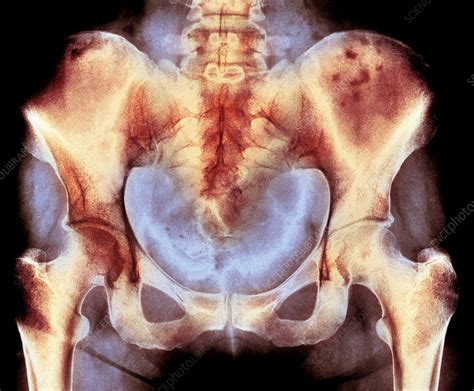 Bone marrow cancer, X-ray - Stock Image - C020/7257 - Science Photo Library