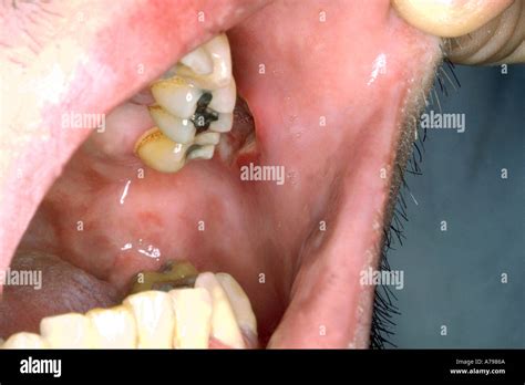 Mouth ulcers HIV Stock Photo: 497770 - Alamy