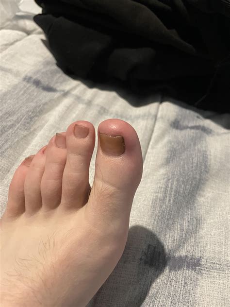 Suffering from this for years I think it’s chilblains big toe red feels