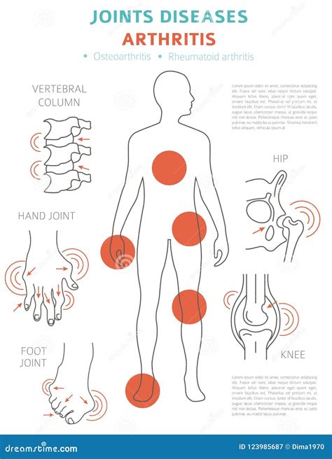 Joints Diseases. Arthritis Symptoms, Treatment Icon Set Stock Vector