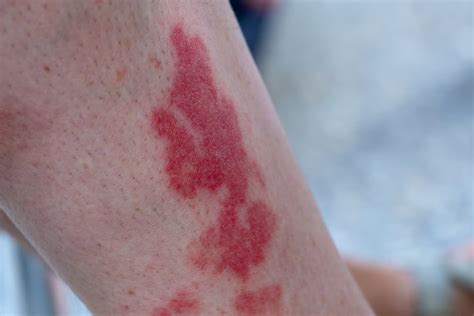 Combatting Hiker’s Rash: Prevention and Treatment Strategies for ...