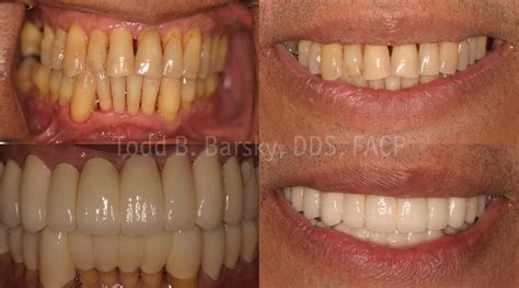 Dental Crowns Archives - Todd B. Barsky, DDS