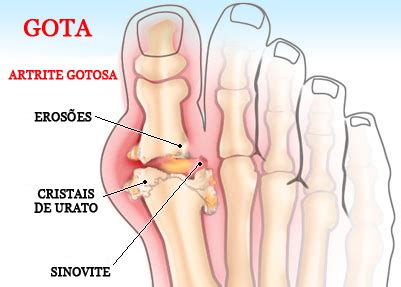 O Que Causa Gota No Pé - Clínica e Cirurgia do Pé e Tornozelo: Gota e Artrite Reumatóide