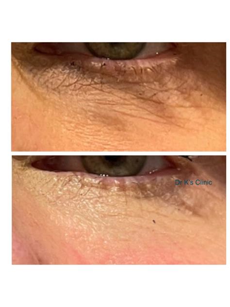 Polynucleotide Treatments in Wrexham | Skin Renewal