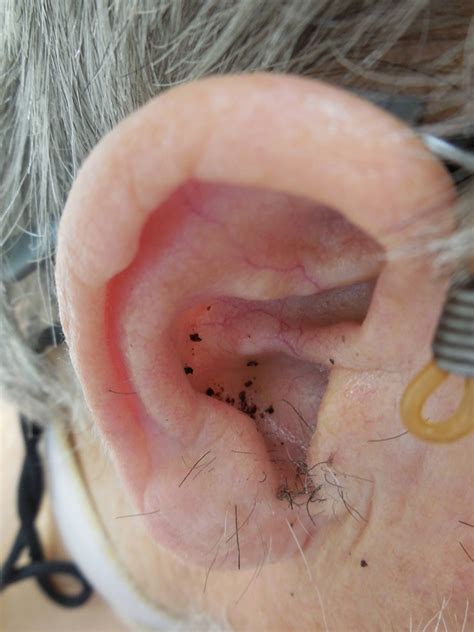 Terra firma-forme dermatosis: A report of ten individuals with Duncan's ...