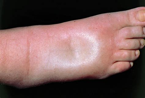EDEMA – Dermatology Conditions and Treatments