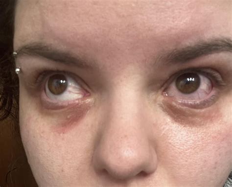 Goggles Rash Around Eyes at Edna Rice blog