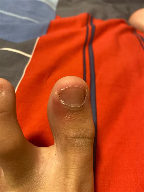 Should I keep an eye on this? (Only mildly painful with pressure) : r