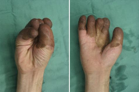 Degloving Injury | Plastic Surgery Key
