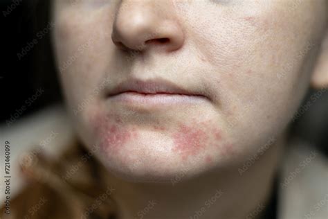 perioral dermatitis  woman face closeup dermatitis  skin ill