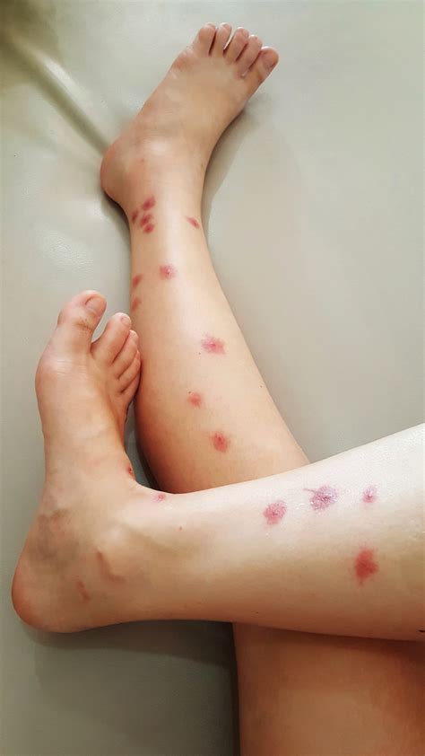 Sea Lice or Seabather's Eruption - Katu Dermatology Clinic