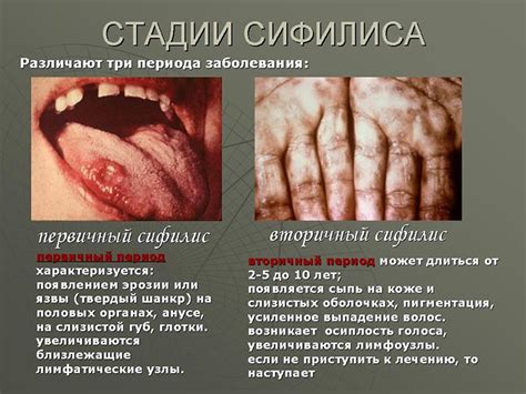Заражение сифилисом: способы передачи инфекции
