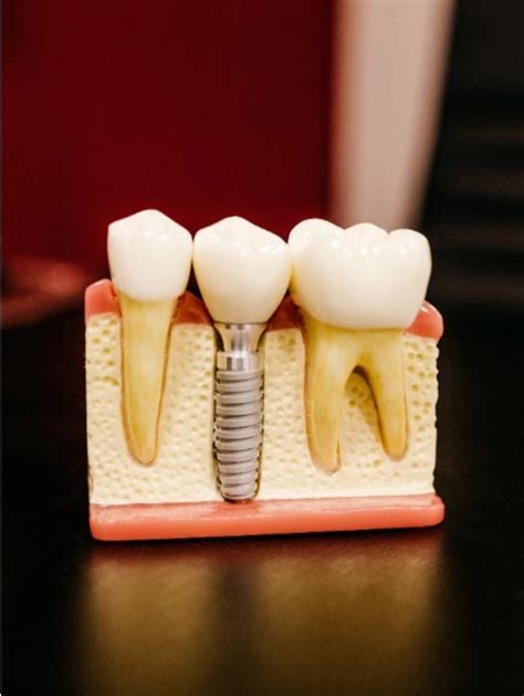 Dental Implants | Dr. Morgan | Vero Beach Dentist