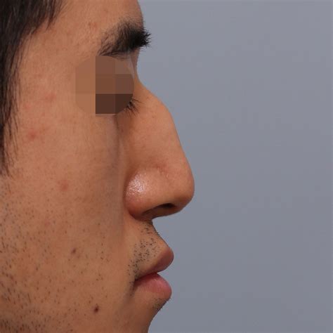 Reshaping male nose by hooked nose rhinoplasty – HANABI RHINOPLASTY CLINIC