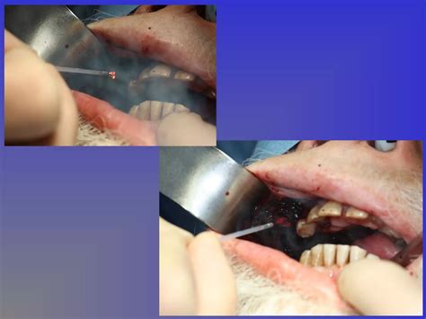 Lasers in oral and maxillofacial surgery | PPT