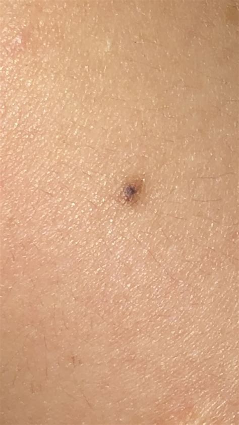 Mole or melanoma? : r/Melanoma